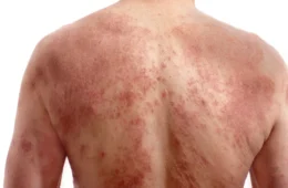 Sarna humana: o que é, como se pega, quais os sintomas e como tratar a doença