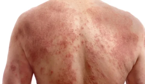 Sarna humana: o que é, como se pega, quais os sintomas e como tratar a doença