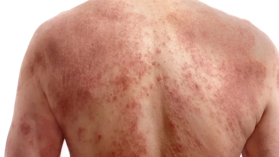 Sarna humana: o que é, como se pega, quais os sintomas e como tratar a doença