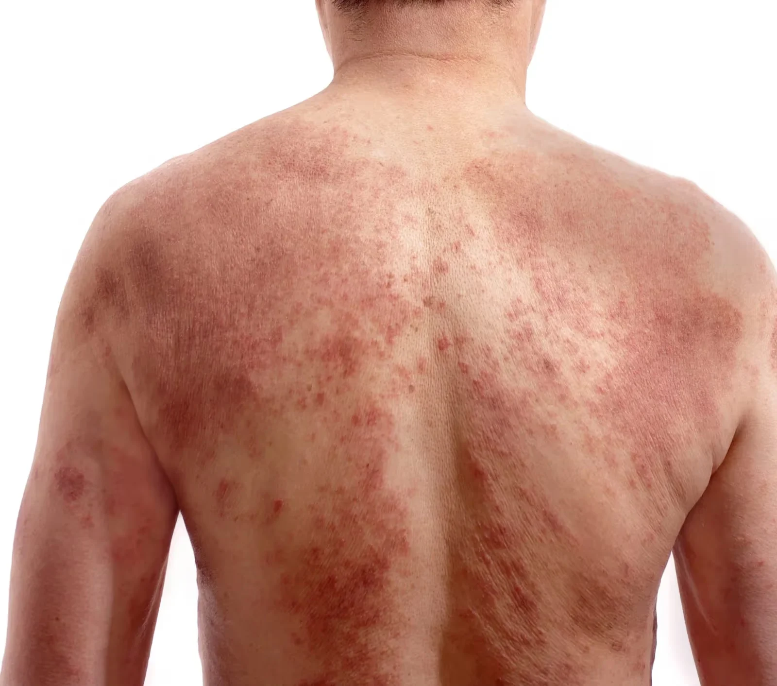 O sintoma mais característico da escabiose é a coceira intensa, frequentemente mais forte durante a noite. Também podem surgir pequenas lesões avermelhadas, bolhas e irritações na pele.
