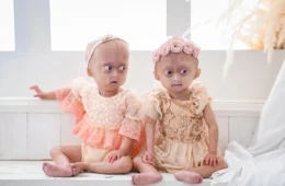 Mãe homenageia gêmea com síndrome da velhice precoce que morreu aos 5 anos: “Ria por tudo”