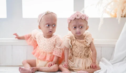 Mãe homenageia gêmea com síndrome da velhice precoce que morreu aos 5 anos: “Ria por tudo”