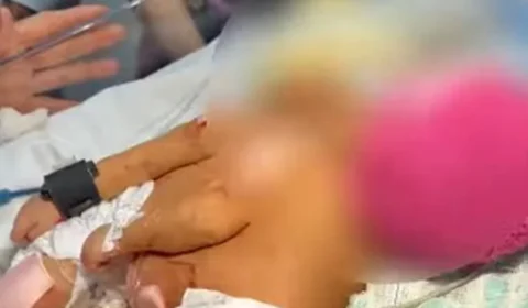 Gêmeas siamesas nascem no DF e passam por avaliação para possível cirurgia de separação