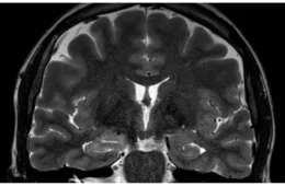 Mulher tem convulsões durante menstruação e médicos suspeitam de endometriose cerebral