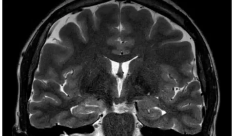 Mulher tem convulsões durante menstruação e médicos suspeitam de endometriose cerebral