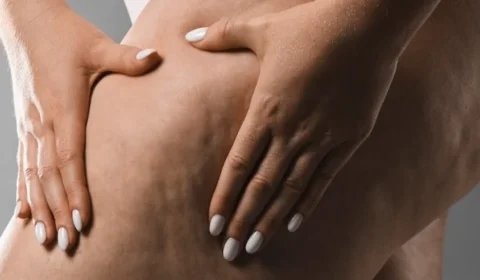 Lipedema pode atingir 12,3% das mulheres; conheça os principais sintomas