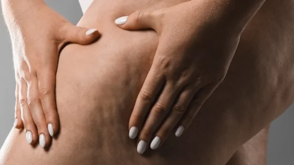 Lipedema pode atingir 12,3% das mulheres; conheça os principais sintomas