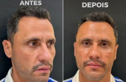 Eleito e “harmonizado”: Cleitinho faz procedimentos no rosto após campanha