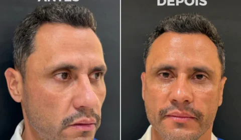 Eleito e “harmonizado”: Cleitinho faz procedimentos no rosto após campanha