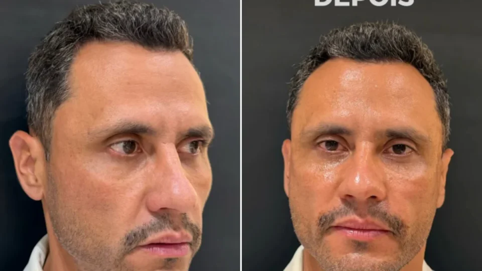 Eleito e “harmonizado”: Cleitinho faz procedimentos no rosto após campanha