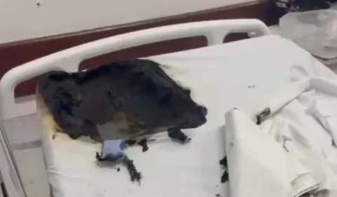 Paciente usa desodorante e isqueiro para atear fogo em homem internado no Rio