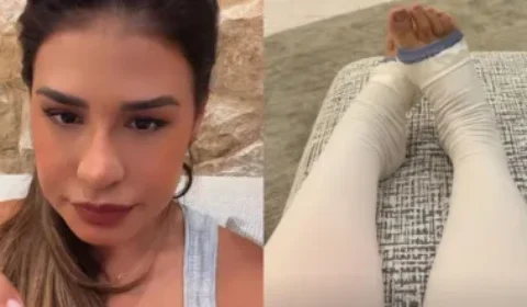 Simone Mendes revela retirada de 4 kg de pele em cirurgia ligada ao lipedema